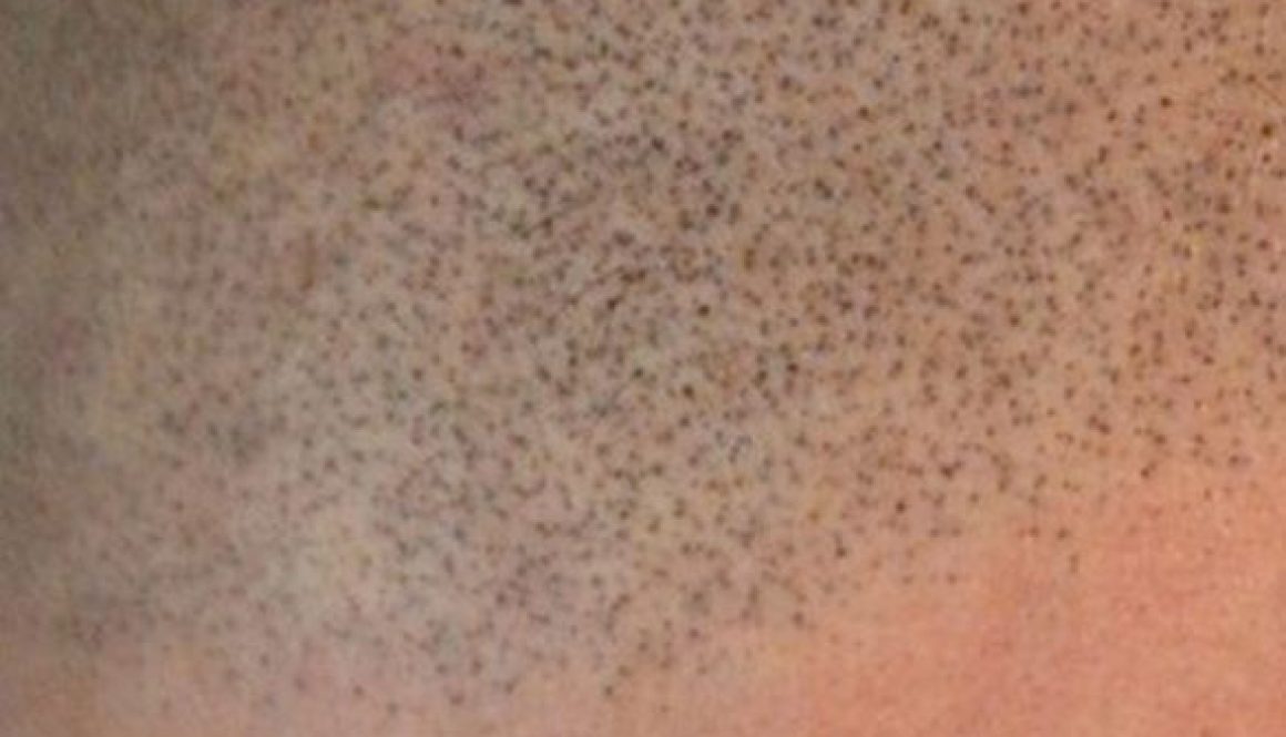 Is the Hair Loss Treatment Scalp Micropigmentation (SMP) Safe for Patients with Scalp Psoriasis?