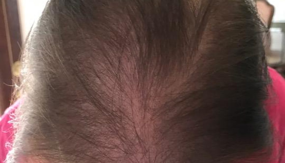 Is Hair Transplant Surgery Recommended for Diffuse Female Hair Loss?