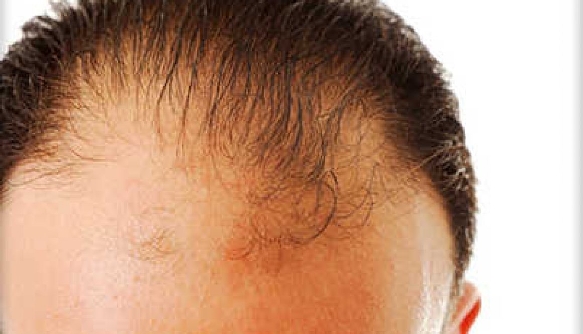 Suffering from Hair Loss for 5/6 Years, Which Drugs work?