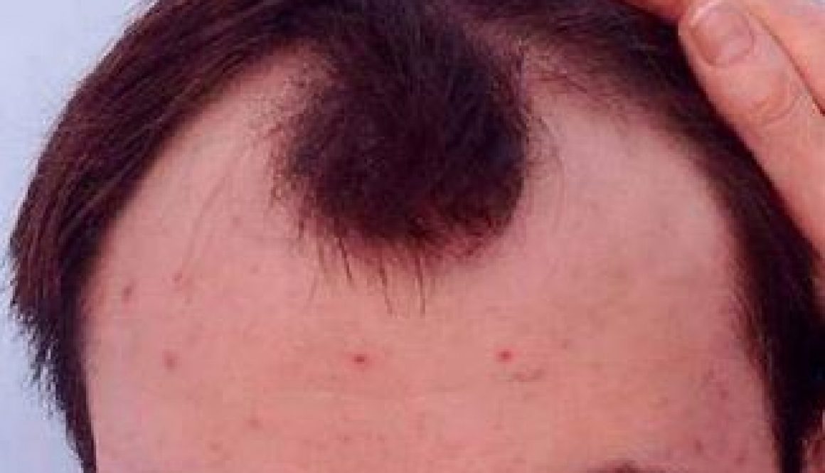 Does a Solid Frontal Tuft Mean Fewer Grafts Required for Hair Transplant Surgery?