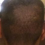 Did My FUE Hair Transplant Surgeon Over Harvest My Donor Area?