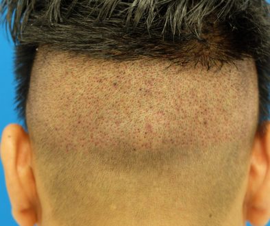 Undergoing FUT “Strip” Surgery After FUE Hair Transplantation