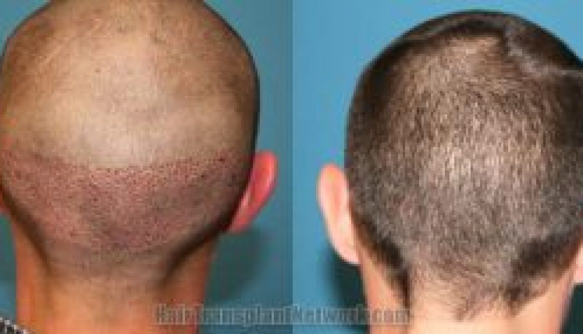 Still Sore and Numb 4 Weeks After Hair Transplant Surgery