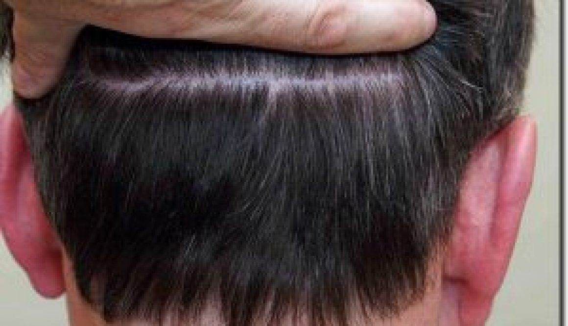 After a Hair Transplant, Does the Donor Hair Grow Back?