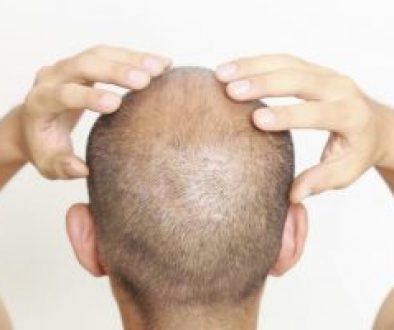 scalp-tightness-exercises