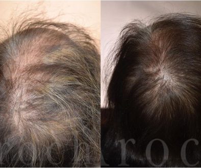 Oral Flutamide Hair Loss