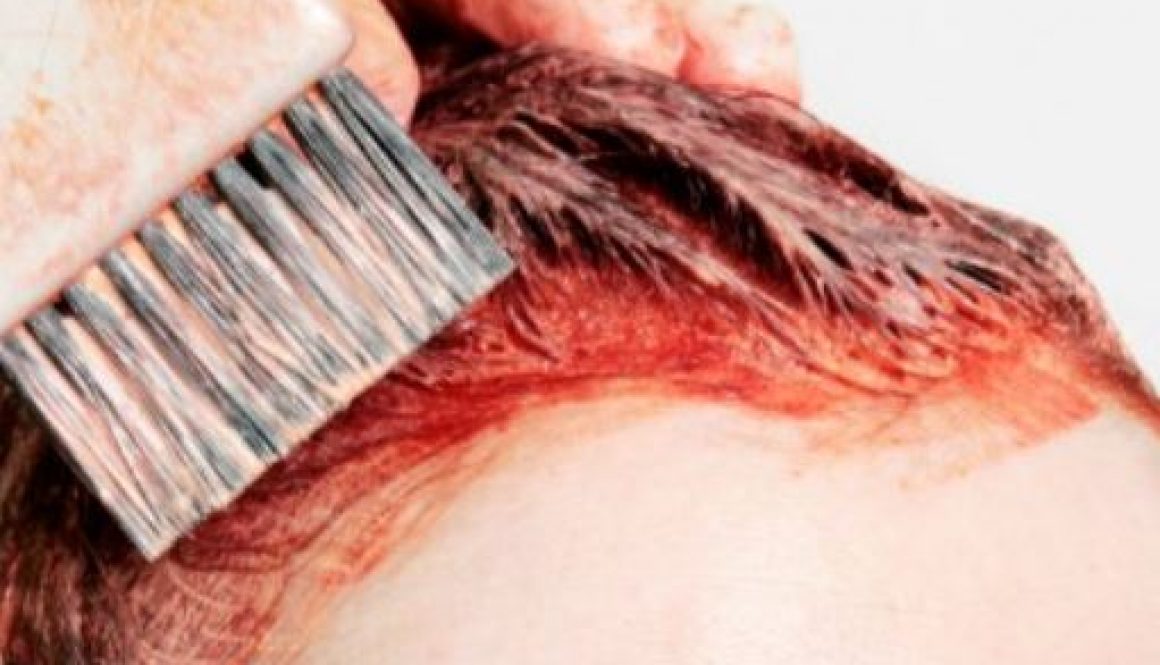 When Is It Safe to Color Hair after a Hair Transplant?