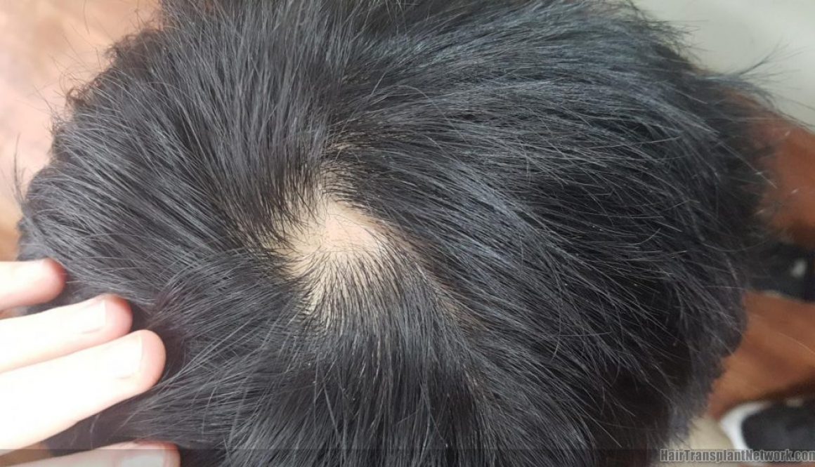 Teenage Hair Loss or Natural Crown Whorl?