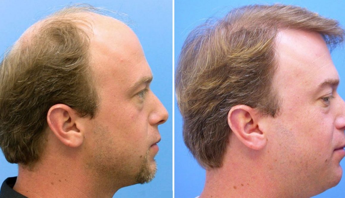 What is the Average Wait Time Between Hair Transplants?