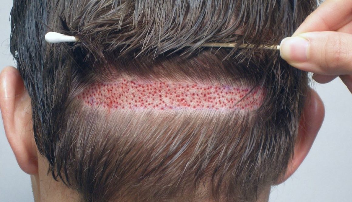 Is Doing 8000 Grafts with Follicular Unit Extraction (FUE) Possible and Realistic?