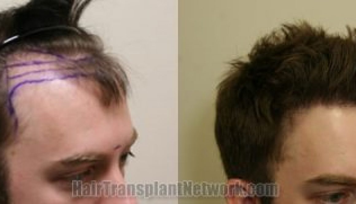 Deciding Between Density and Coverage with Hair Transplant Surgery