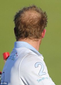 Can Prince Harry save his hair?