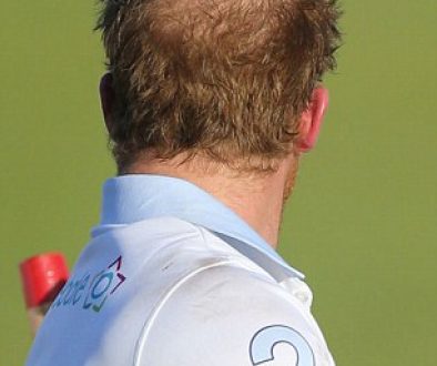 Can Prince Harry save his hair?