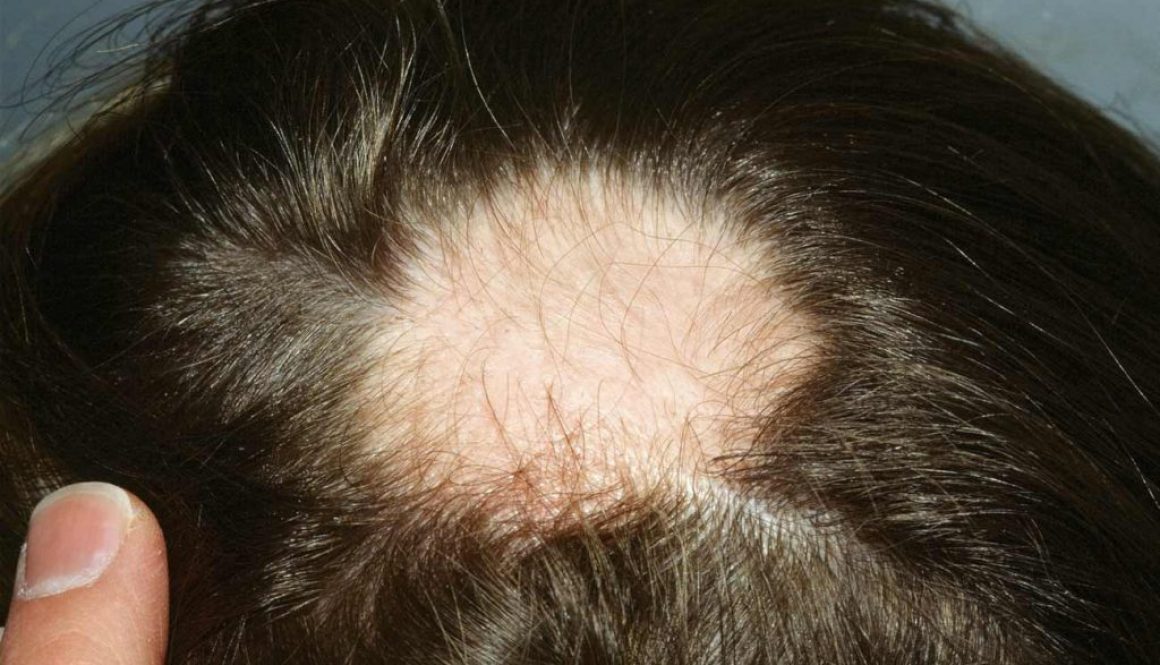 Can I Have A Hair Transplant To Treat Alopecia Areata?