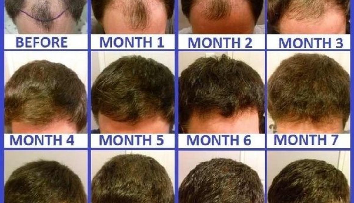 What Is The Process Following a Hair Transplant?