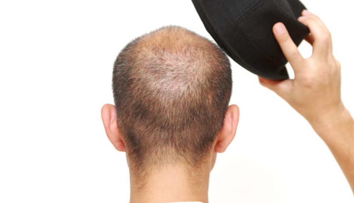 Does Wearing Hats Cause Hair Loss?