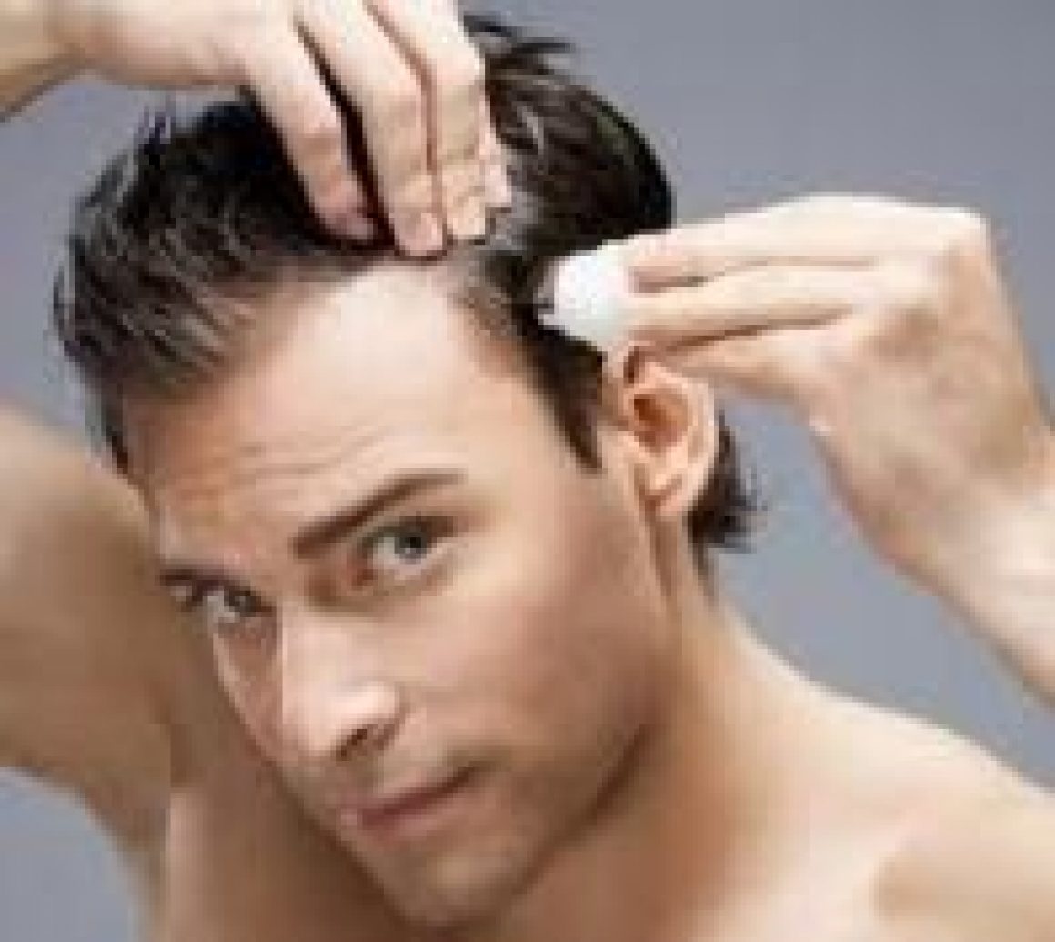 Did Hair Dye Cause my Hair Loss?