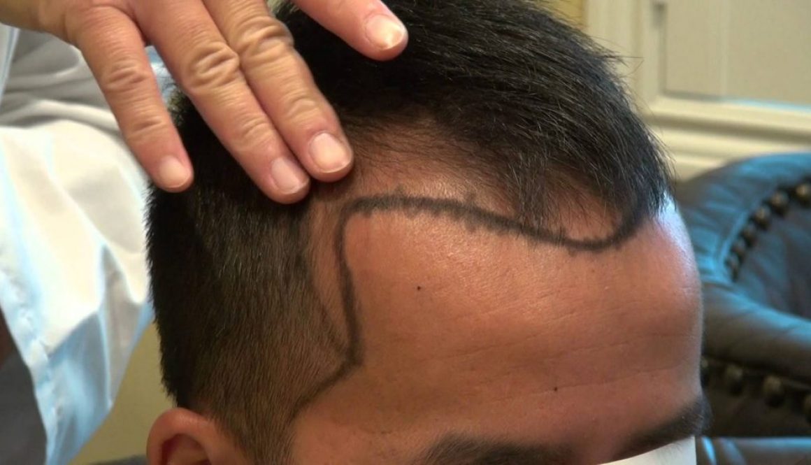 How Long Does Hair Transplant Surgery Last?