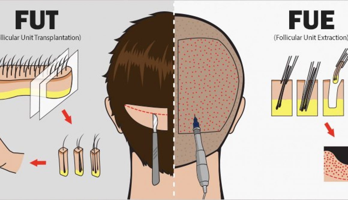 Should I Have An FUE Hair Transplant Or Strip Hair Transplant?