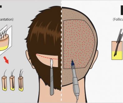 Should I Have An FUE Hair Transplant Or Strip Hair Transplant?