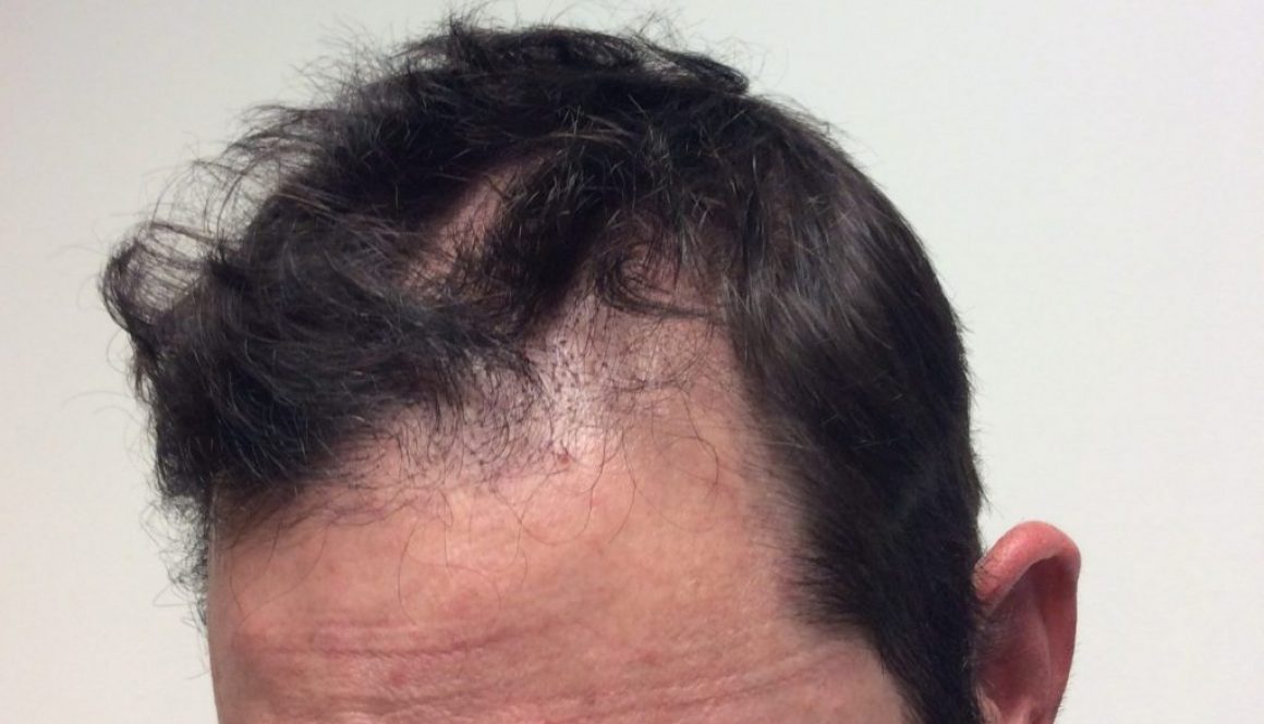 Does Getting A Hair Transplant With Thinning Hair Cause Shock Loss?