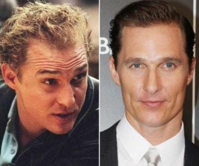 Do Celebrities Go To The Best Hair Transplant Surgeons?