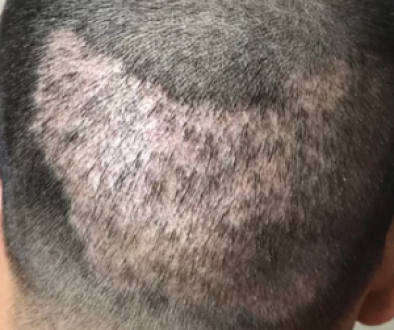 Can I Have A Hair Transplant With A Damaged Donor