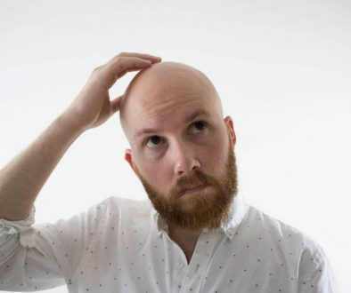 How Many Hair Transplants Can I Have