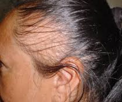 Help! I Have Traction Alopecia