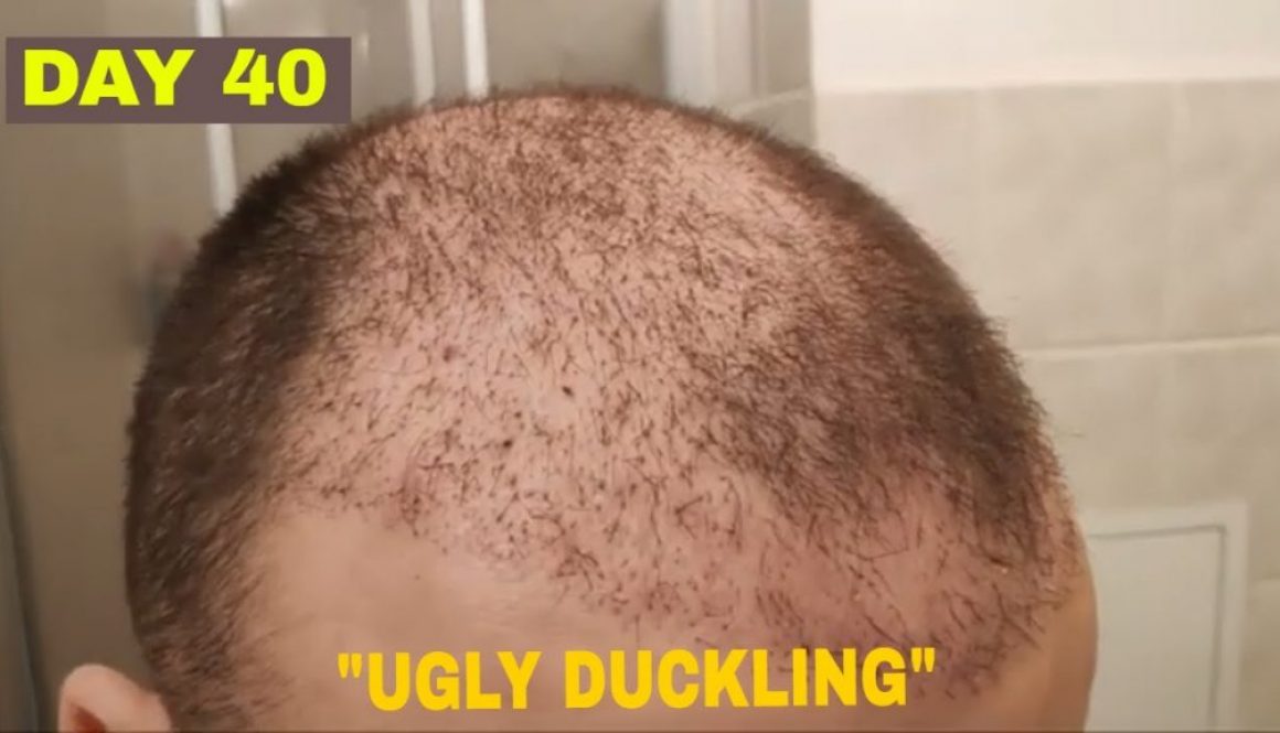 What Is The Hair Transplant Ugly Duckling Phase?