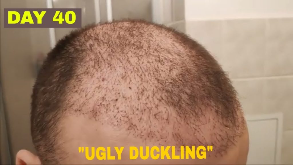 What Is The Hair Transplant Ugly Duckling Phase