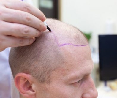 What’s Changed In Field of Hair Restoration In The Last Ten Years? Dr. Charles Answers