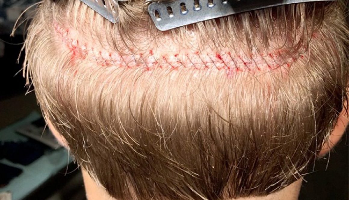 Should I Have A Strip Hair Transplant First?