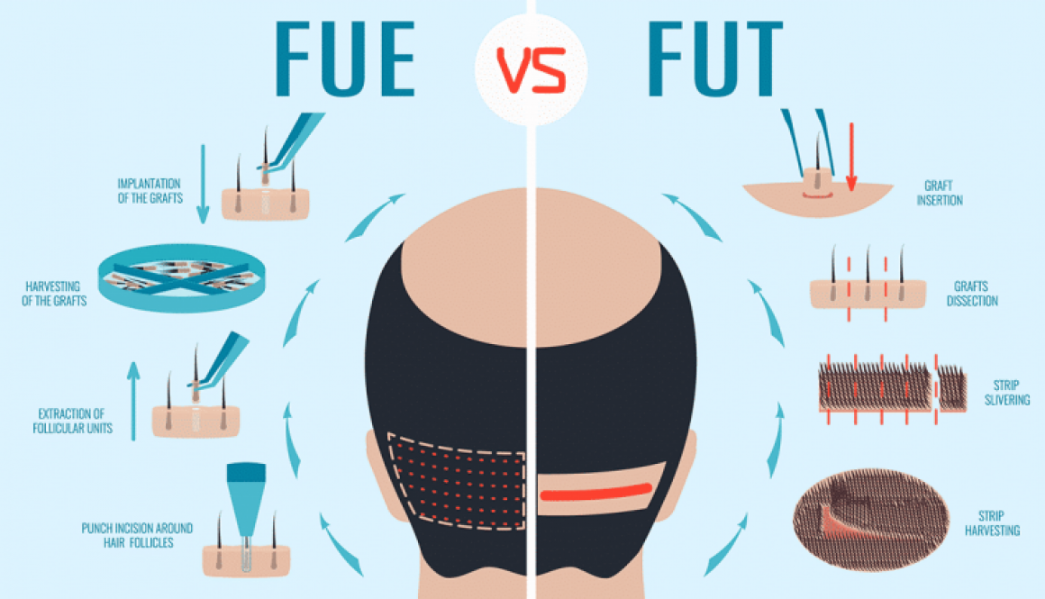 FUE VS FUT Hair Transplant Prices and Differences?