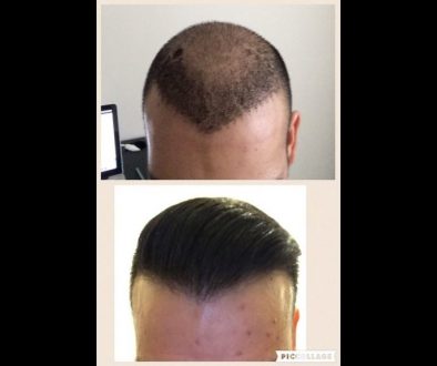 How Many Grafts Do I Need To Get A Dense Hair Transplant?