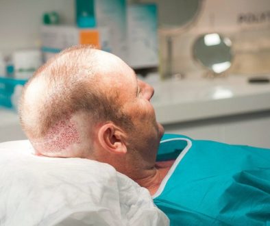 Can You Get A Hair Transplant In Between Existing Hair?