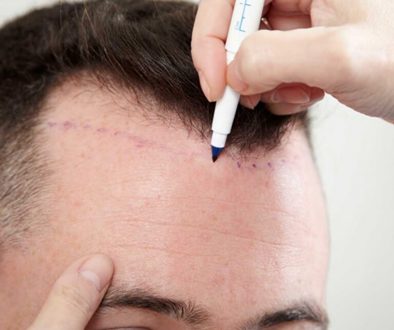 Can I have a Hair Transplant to Lower My Hairline- Lower Than Nature?