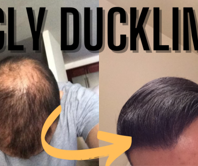 What Is The Hair Transplant Ugly Duckling Phase?