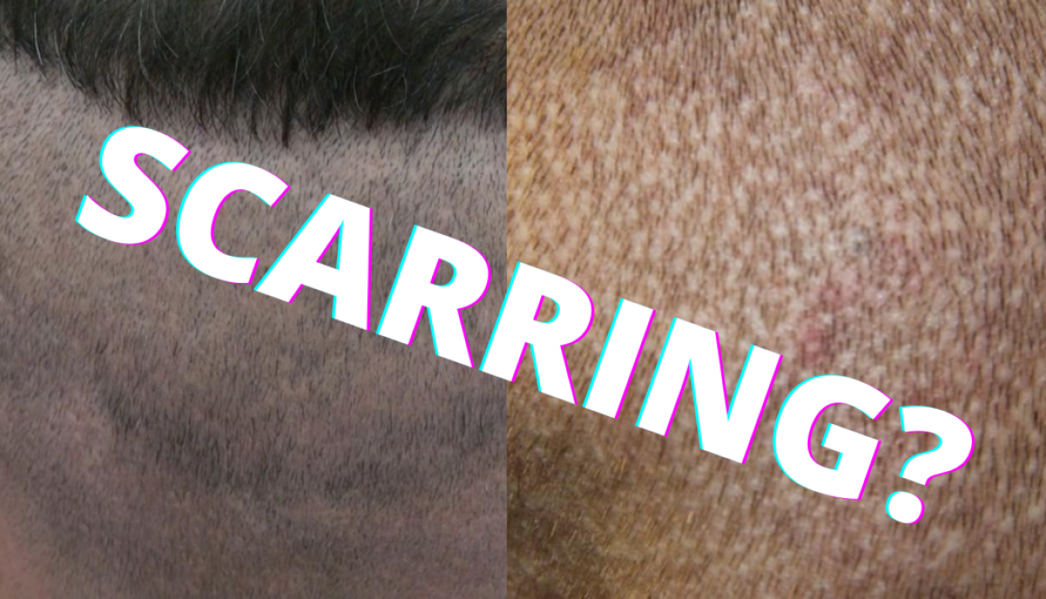 Does FUE Hair Transplant Leave Scars?