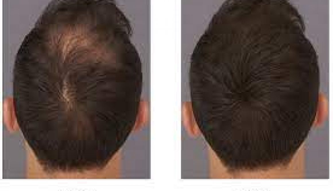 When Can You Use Toppik After A Hair Transplant?