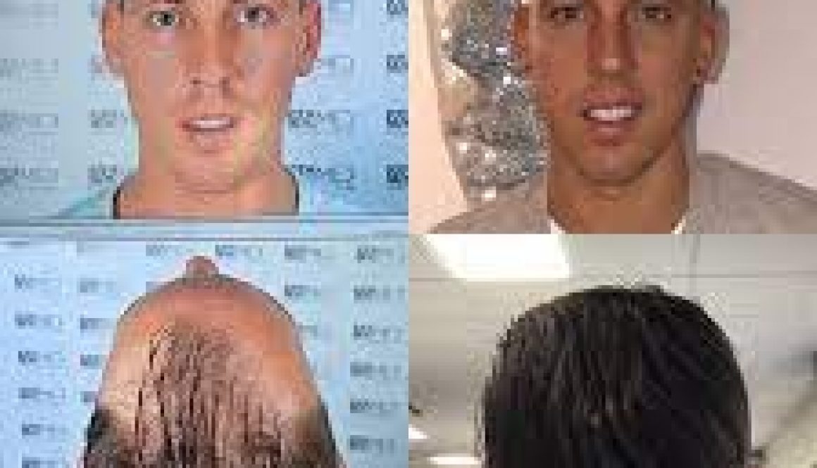 What Is The Success Rate of Hair Transplants?