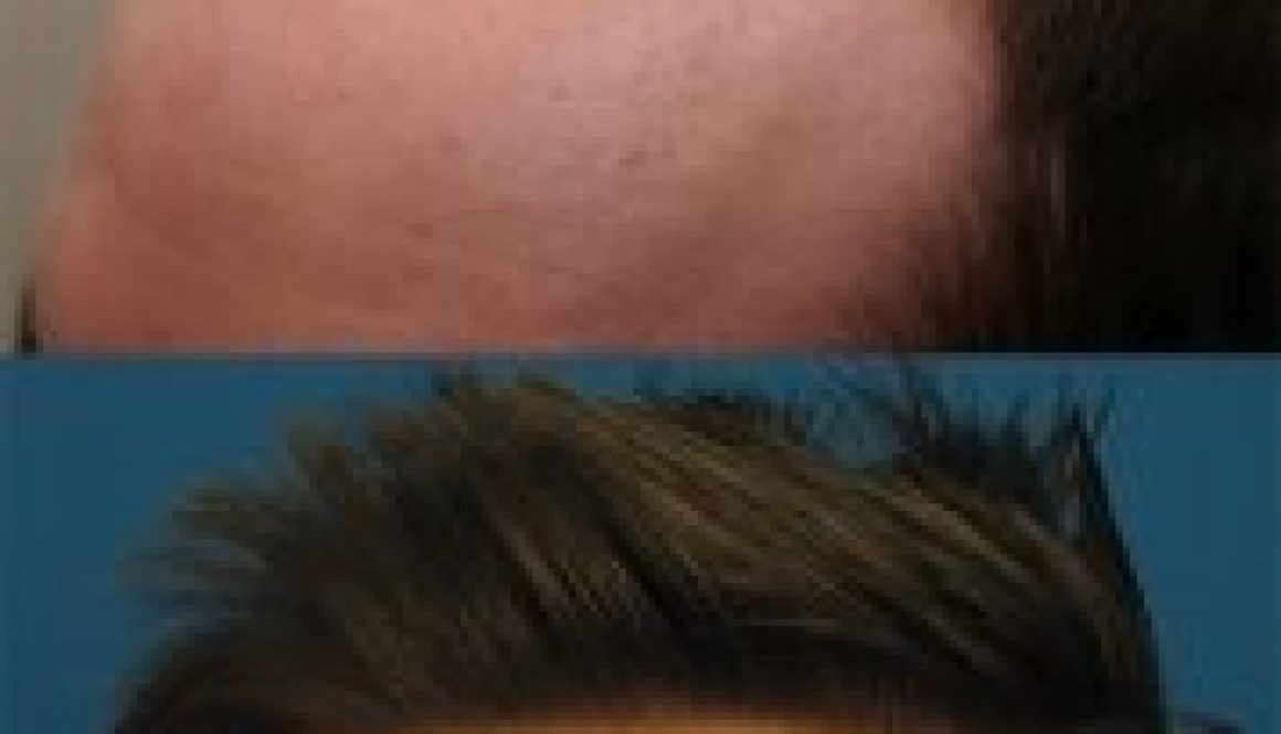 Should I Choose an FUE or FUT Hair Transplant?