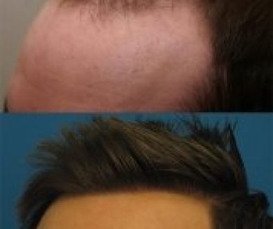 Should I Choose an FUE or FUT Hair Transplant?