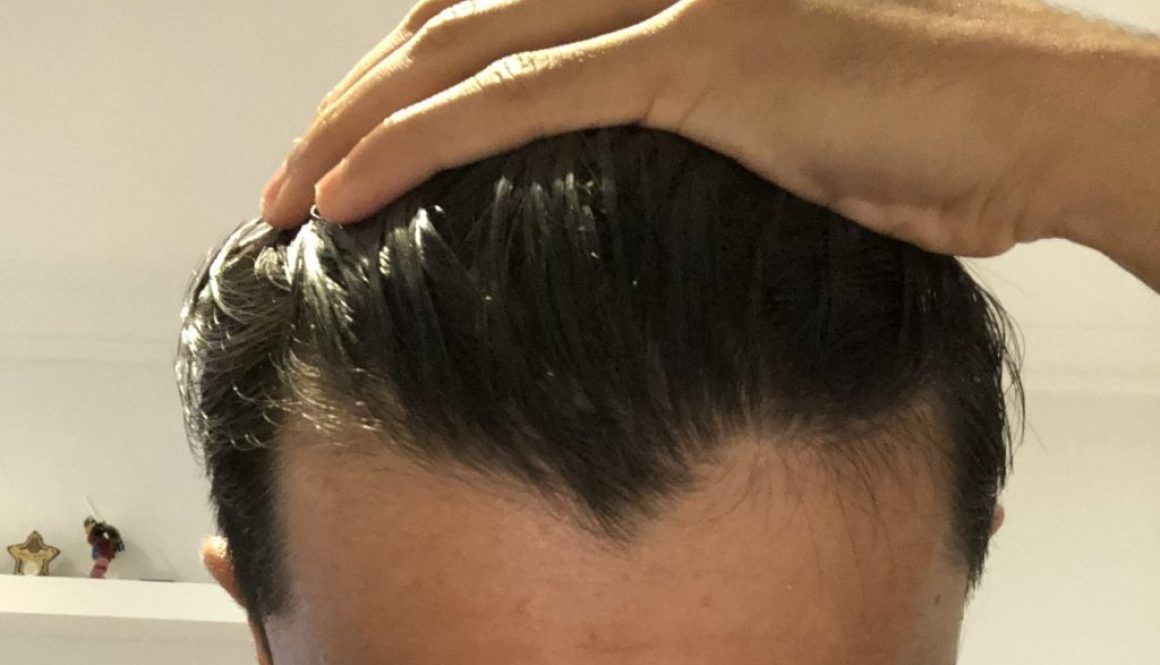 Am I Balding? How To Tell The Signs of Hair Loss