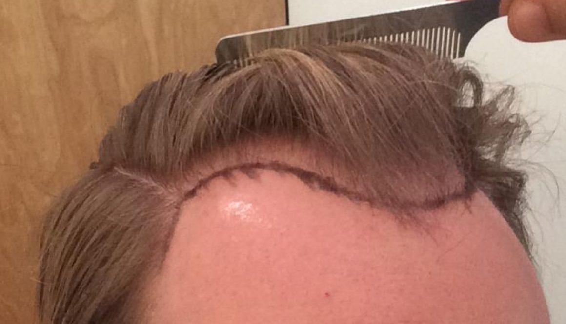 Can I Get an FUE Without Propecia?